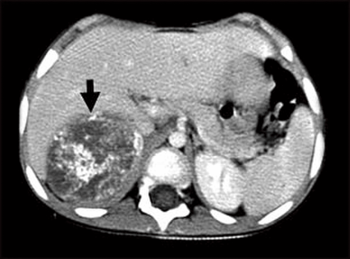 How Neuroblastoma Often Goes Undetected