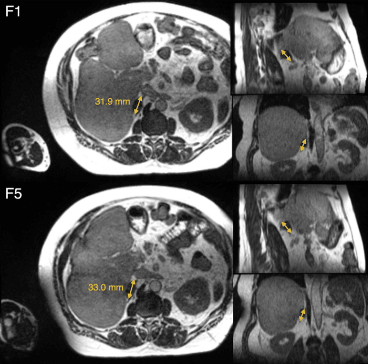 What an MRI Might Tell You About Your Adrenal Glands