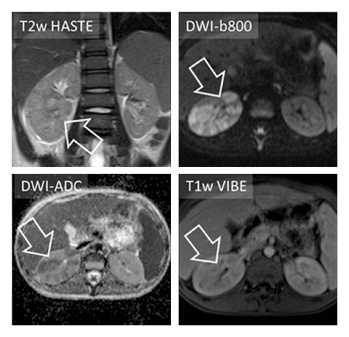 Kidney Cancer: A Year in Research