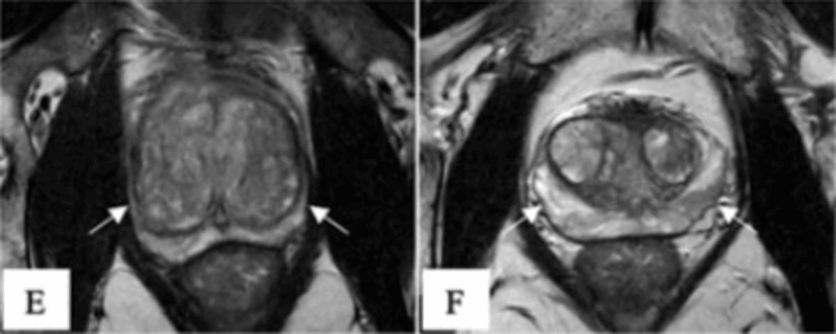 Why Early Detection Is Still the Best Form of Prostate Cancer Prevention