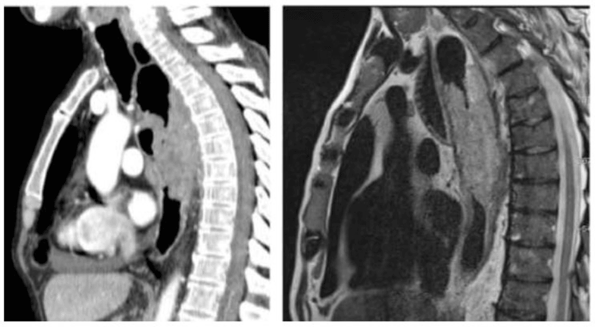 How Modern Imaging Is Helping Oesophageal Cancer Patients Live Longer