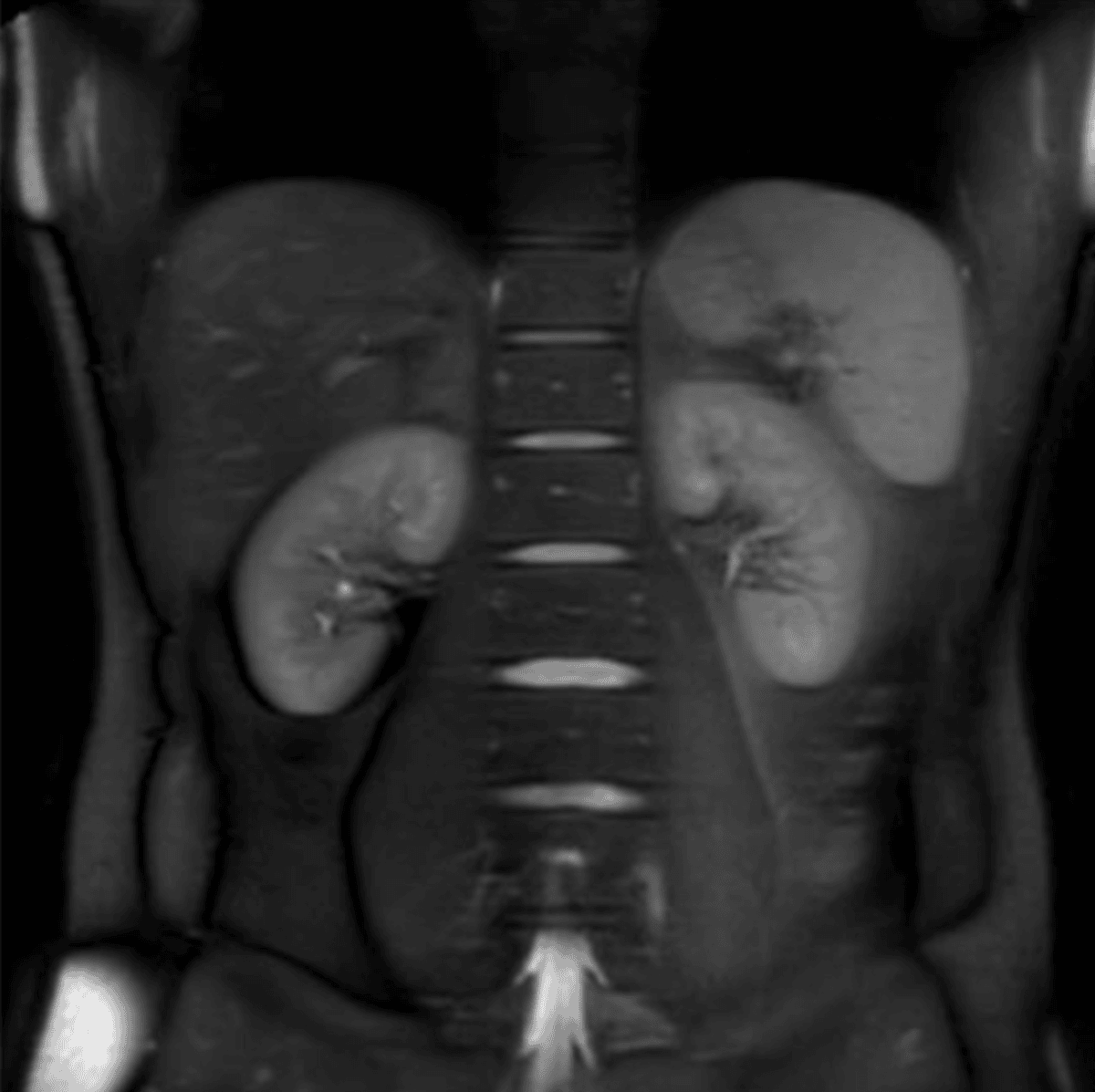 5 Kidney Cancer Risk Factor Claims – Checking the Facts