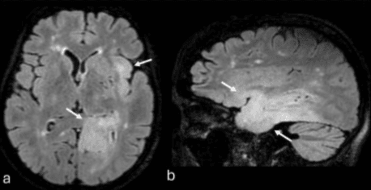 Rare Cancers: Why Awareness Is a Form of Prevention