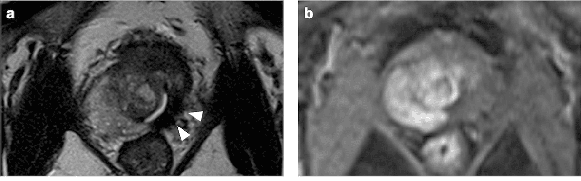10 Early Signs of Prostate Cancer Men Often Ignore