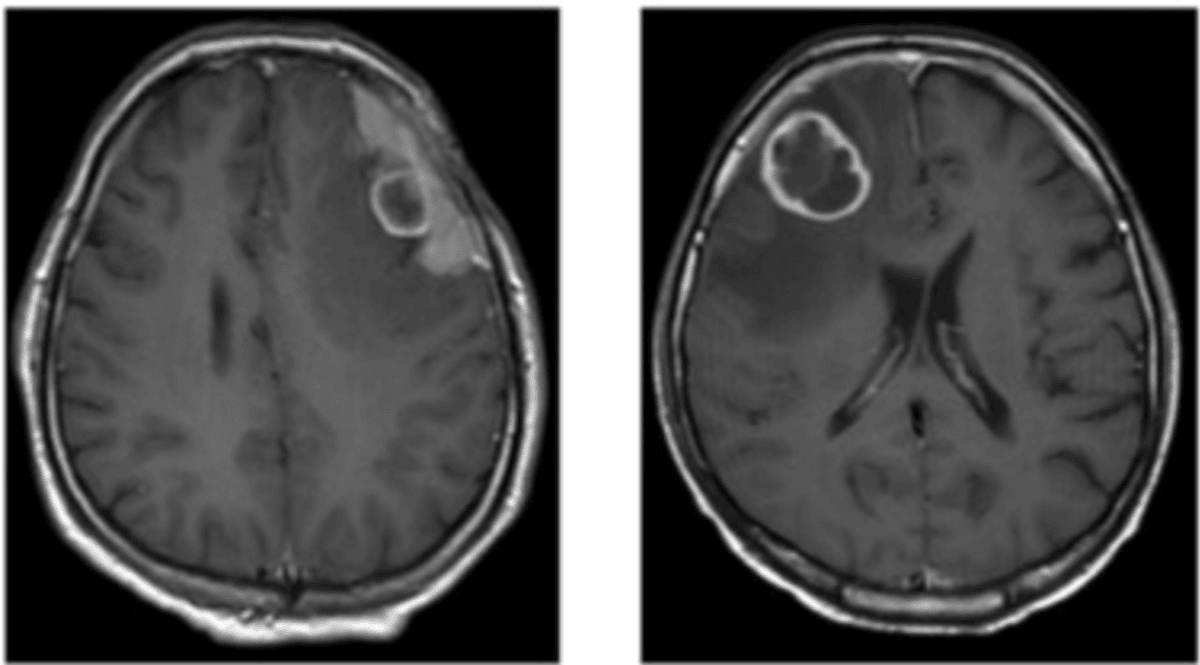 Brain Tumours in the UK: Key Facts Everyone Should Know This March