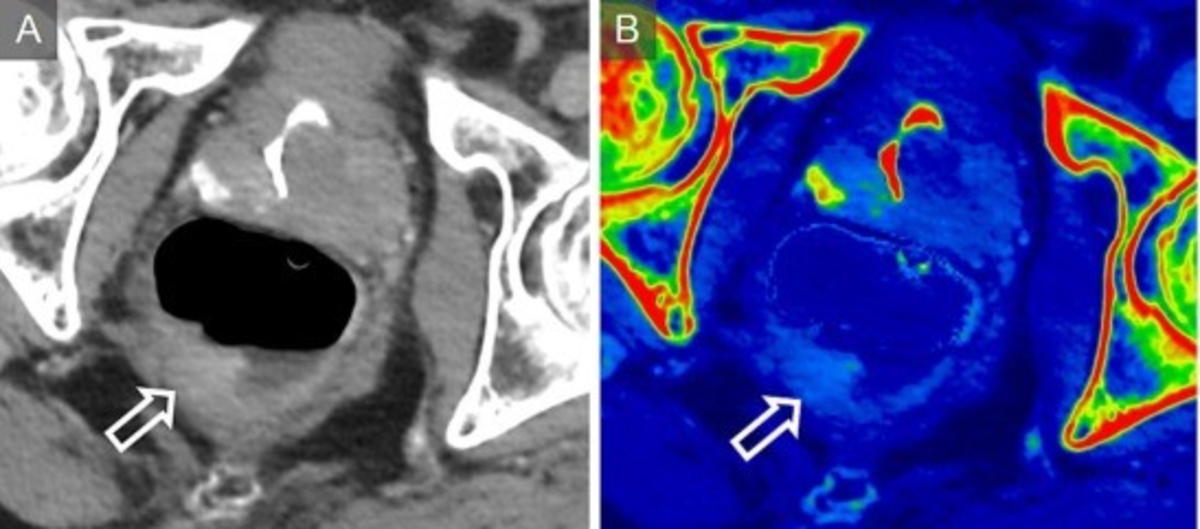 Colorectal Cancer: A Year in Research