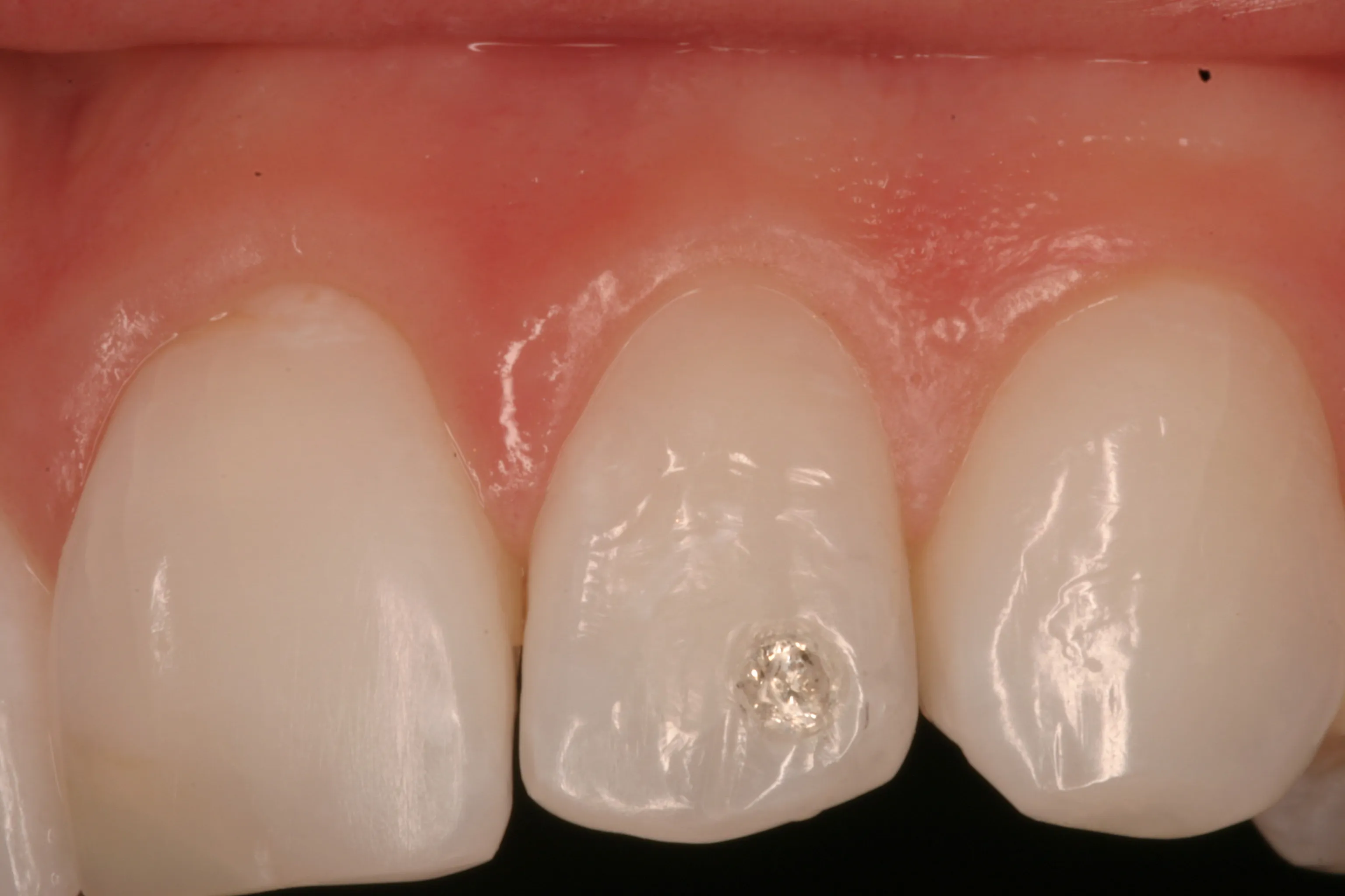 Gallery case 5, after: close-up of front teeth without the dark spot.