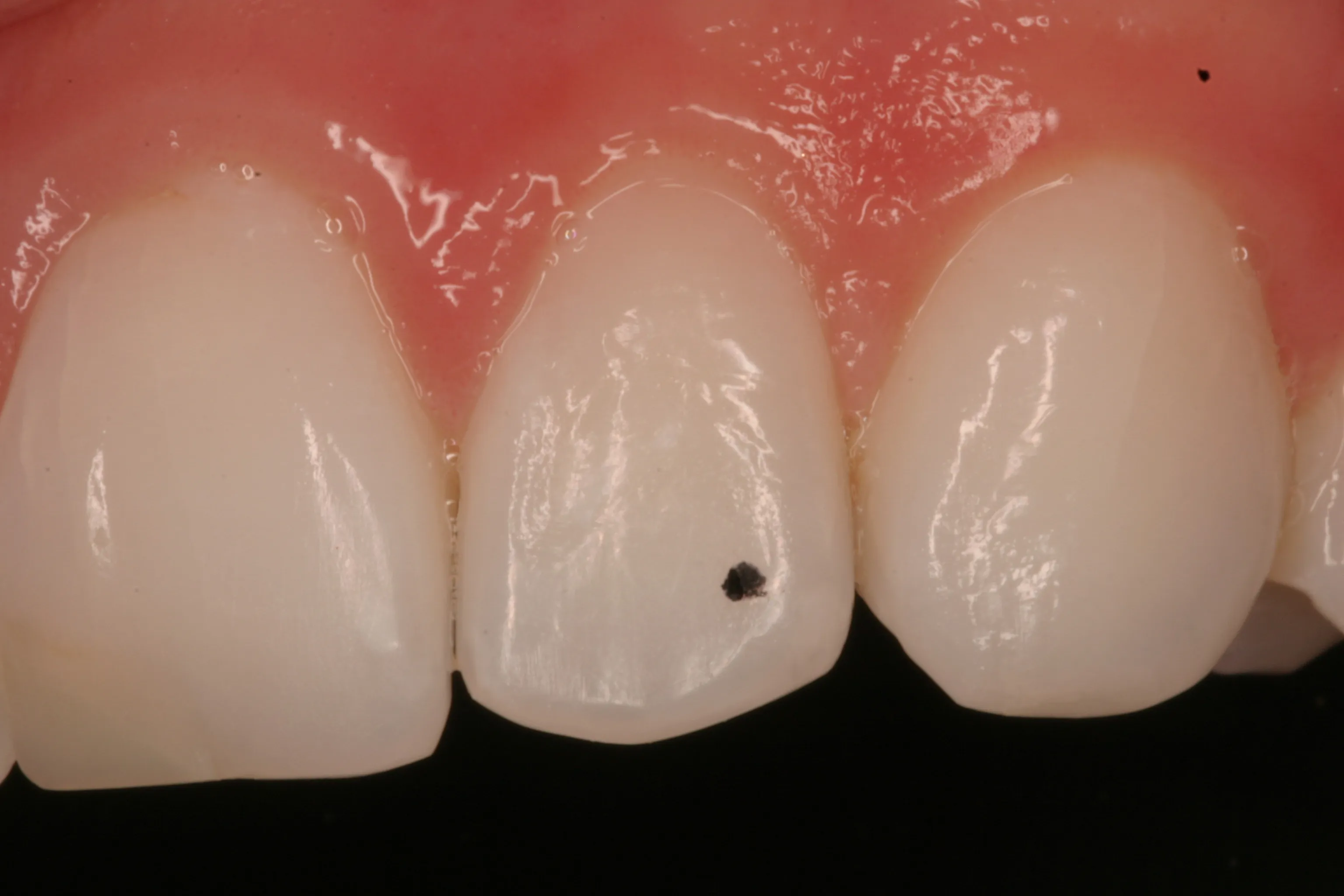 Gallery case 5, before: close-up of a front tooth with a small dark spot near its edge.
