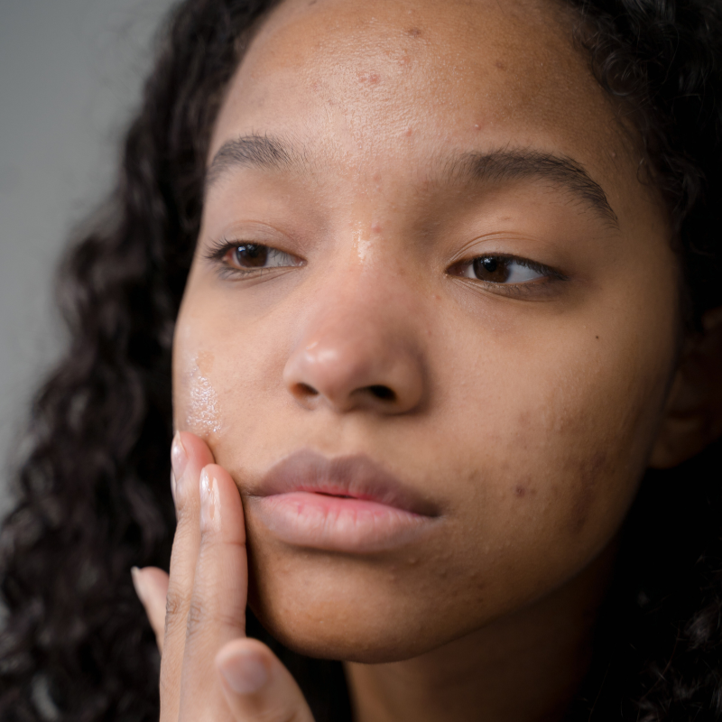 Young woman examining her skin in the mirror with visible acne and irritation on her cheek and forehead and puffyness