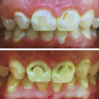 white-spot-lesions