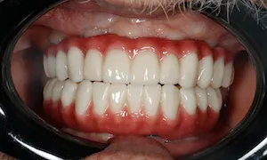 Before and after of patient's teeth after receiving veneers