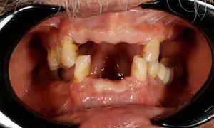 Before and after of patients teeth after a Smiles Family Dentistry Smile Makeover