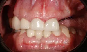 Before and after of patients teeth after a Smiles Family Dentistry Smile Makeover