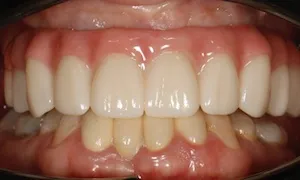 Before and after of patient's teeth after receiving veneers