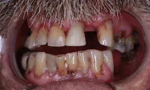 Before and after of patients teeth after a Smiles Family Dentistry Smile Makeover