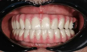 Before and after of patient's teeth after receiving veneers