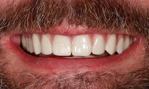 Before and after of patient's teeth after receiving veneers