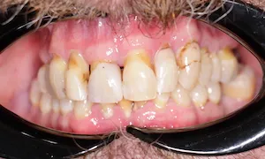 Before and after of patients teeth after a Smiles Family Dentistry Smile Makeover