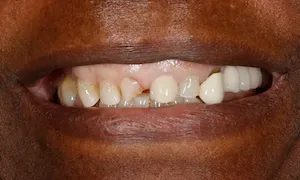 Before and after of patients teeth after a Smiles Family Dentistry Smile Makeover