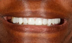 Before and after of patient's teeth after receiving veneers