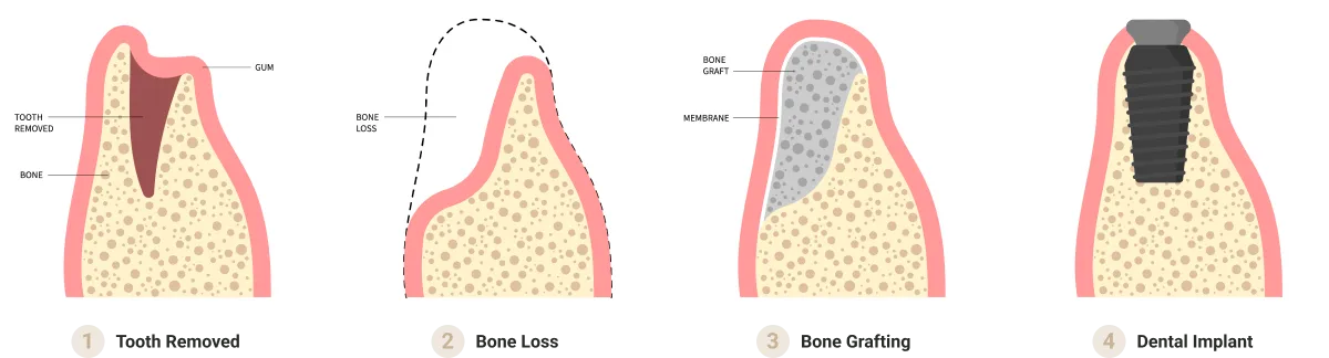 Four step implant process