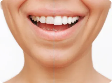 A before and after photo of a veneers at Smiles Family Dentistry in NJ