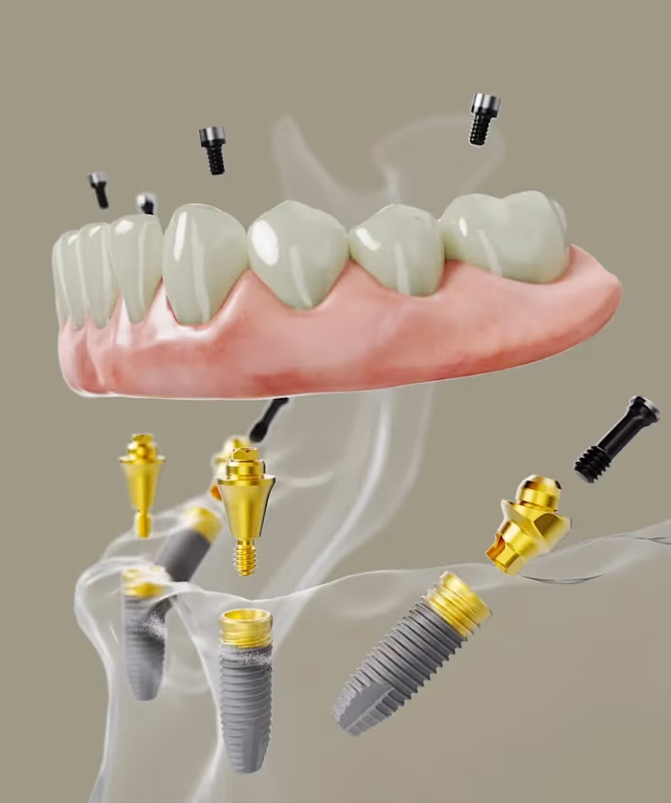 All-on-4 Dental Implants
