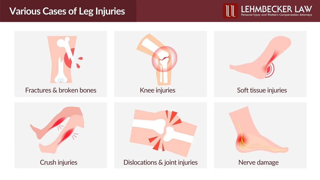 Various Cases of Leg Injuries: Infographic