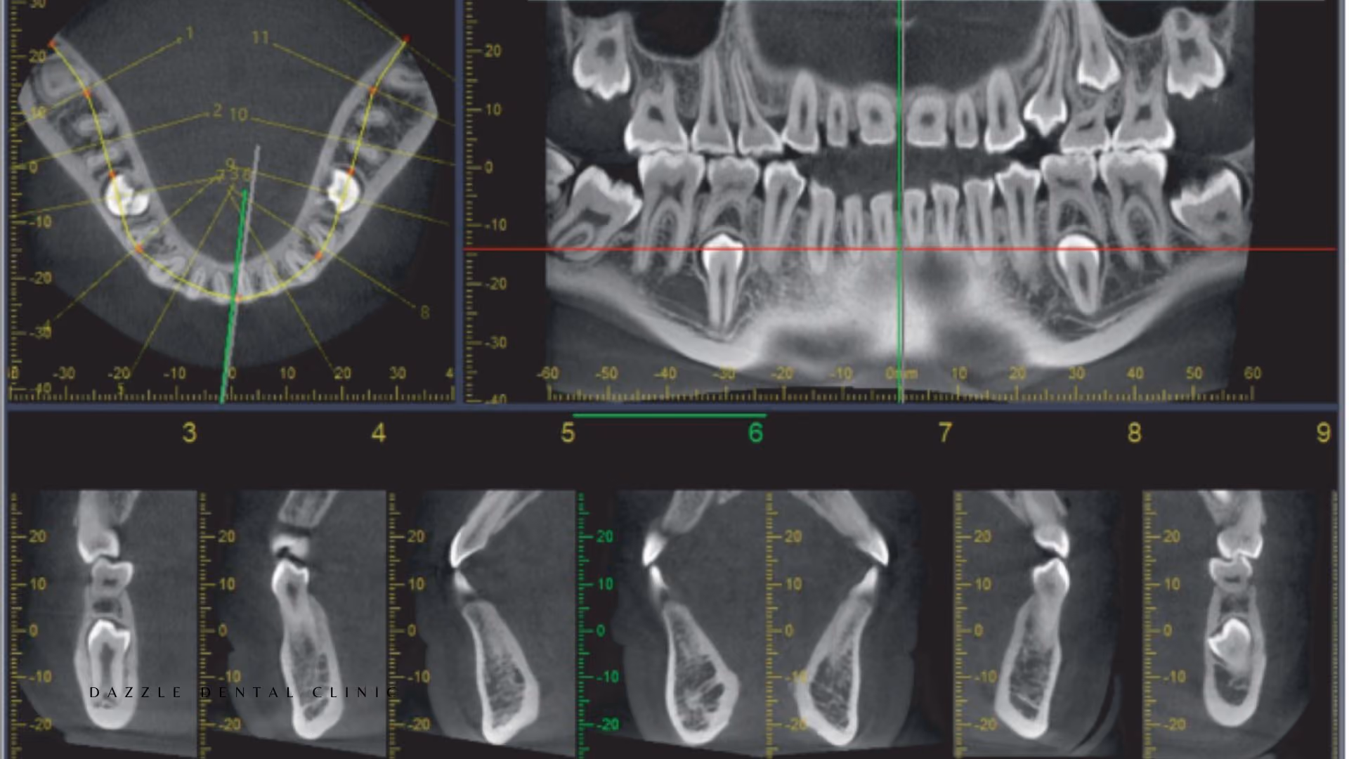 Advanced Radiographic Techniques at Dazzle Dental: CBCT, Cephalometrics, and When Each Imaging Modality Is Used