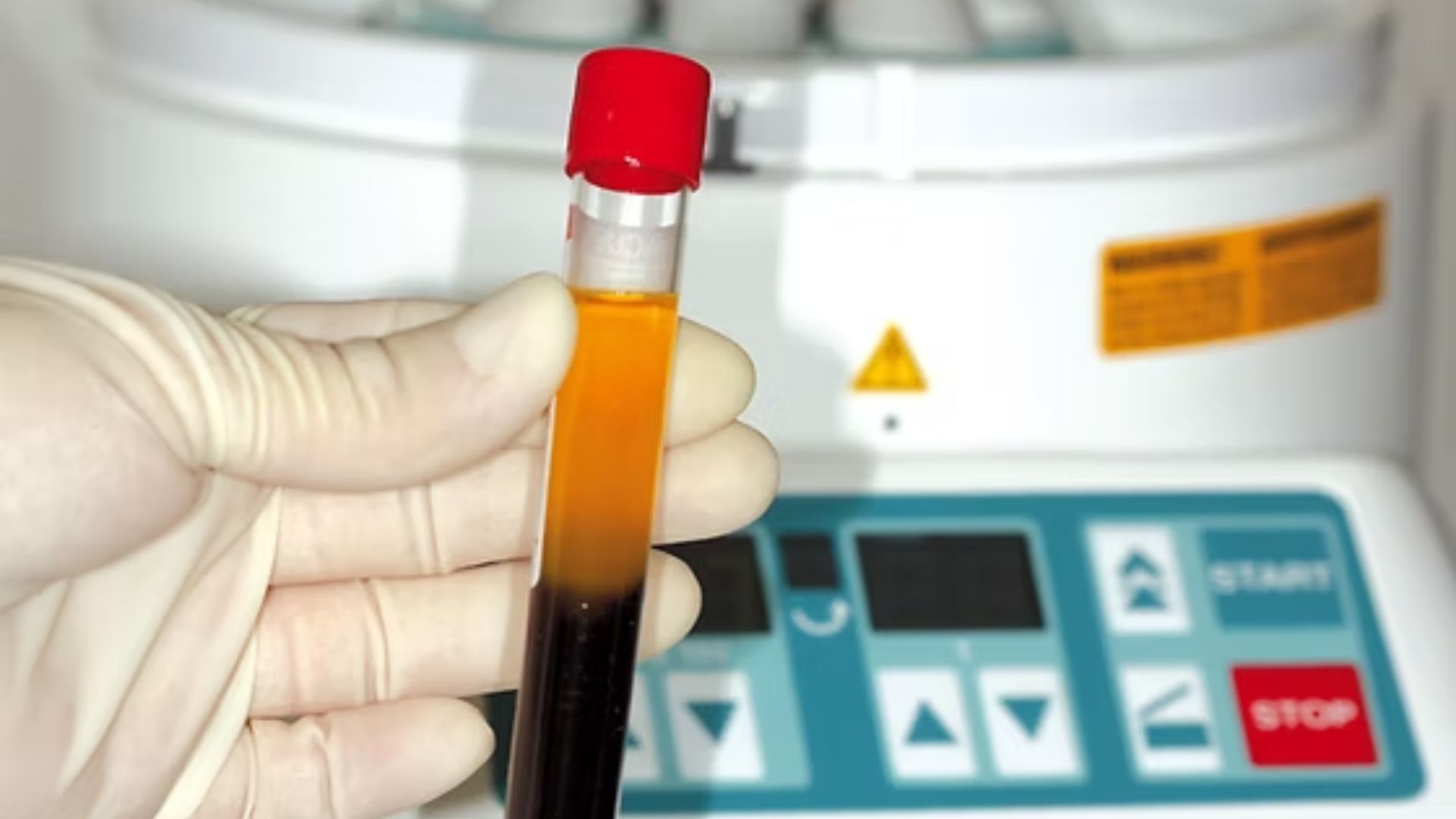 Integration of PRF for Accelerated Healing