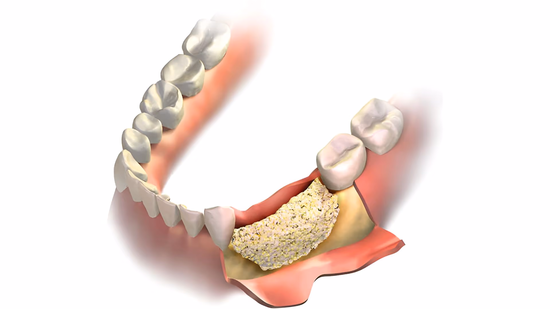 Bone Graft Materials in Regenerative Dentistry: Autograft, Allograft, Xenograft, and Alloplastic Compared