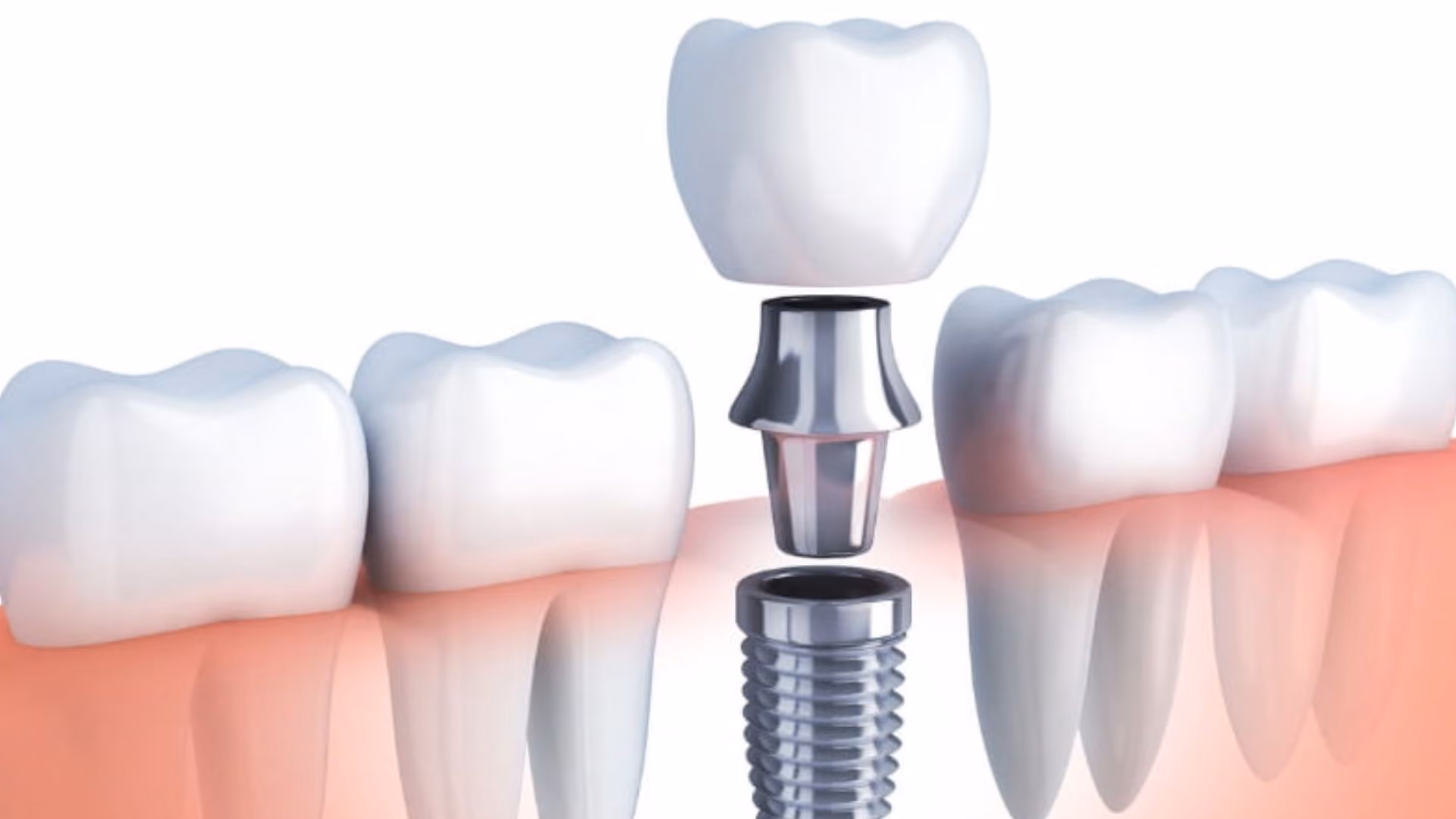 Immediate Loading Dental Implants: Same-Day Teeth Explained Honestly