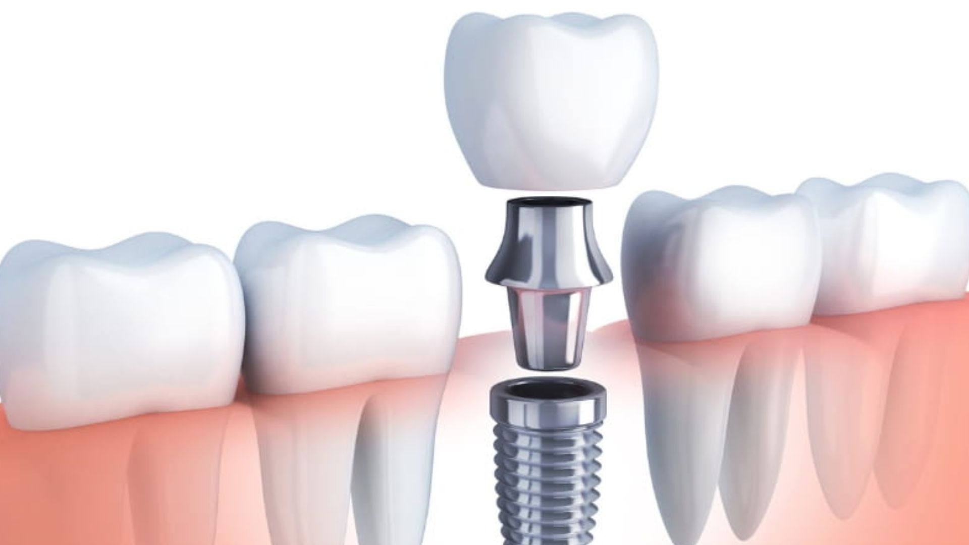 Immediate Loading Dental Implants: Same-Day Teeth Explained Honestly
