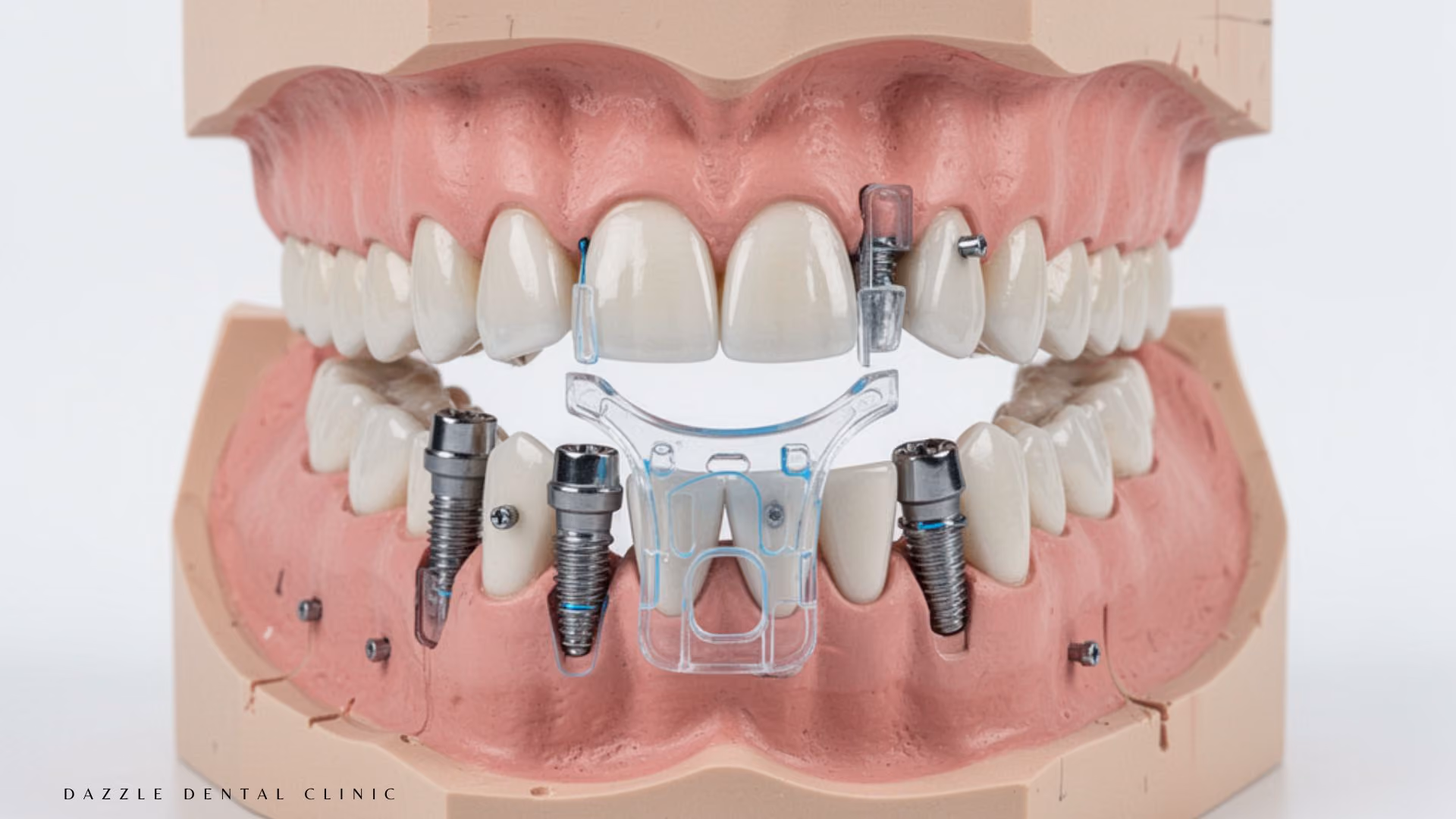 Why Dazzle Dental Clinic's All-on-4 Outcomes Hold Up at 10 Years: Volume, Protocol, and What Failures Teach