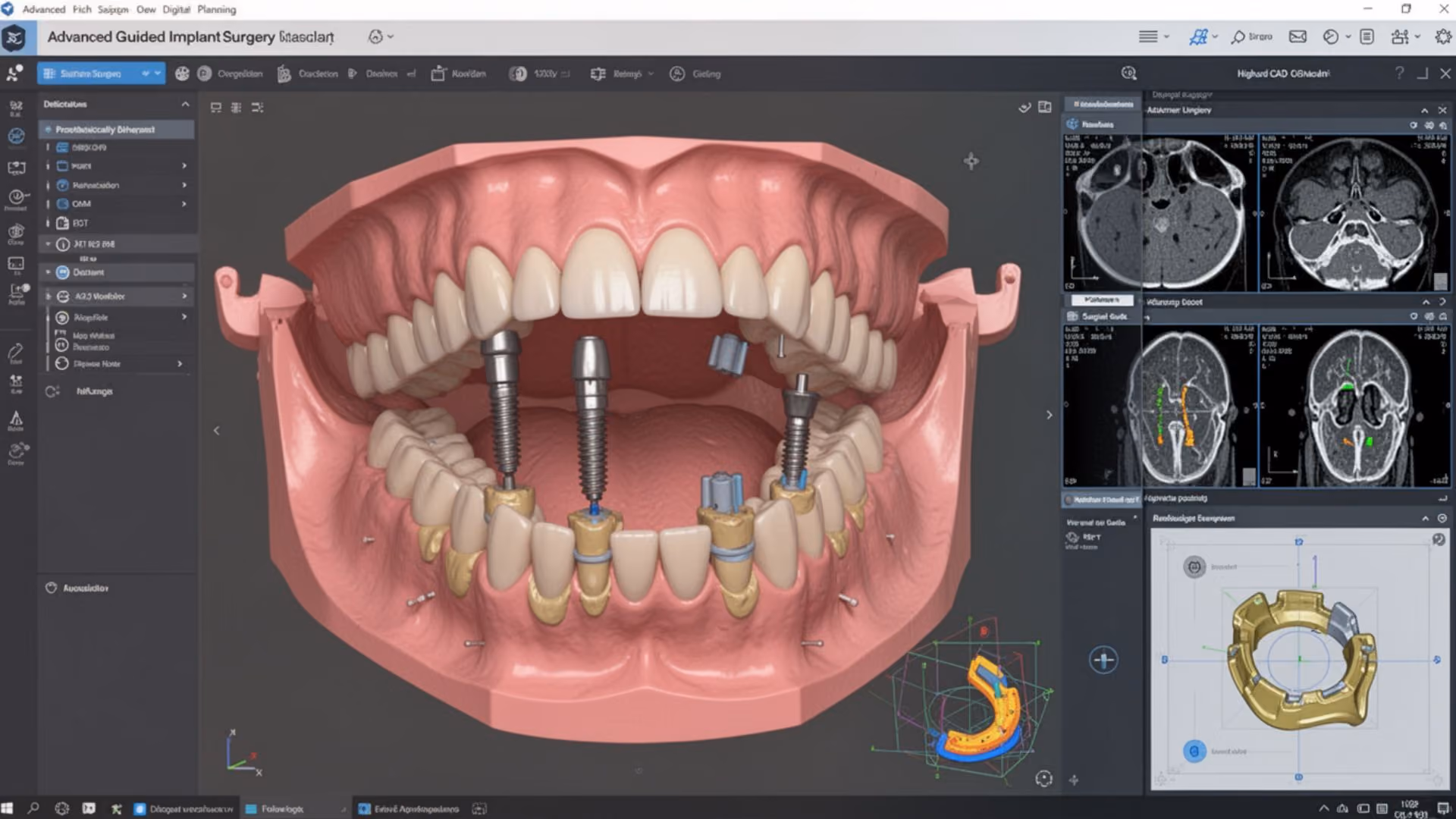 3D Digital Planning for All-on-X Implants: From CBCT Data to Surgical Execution