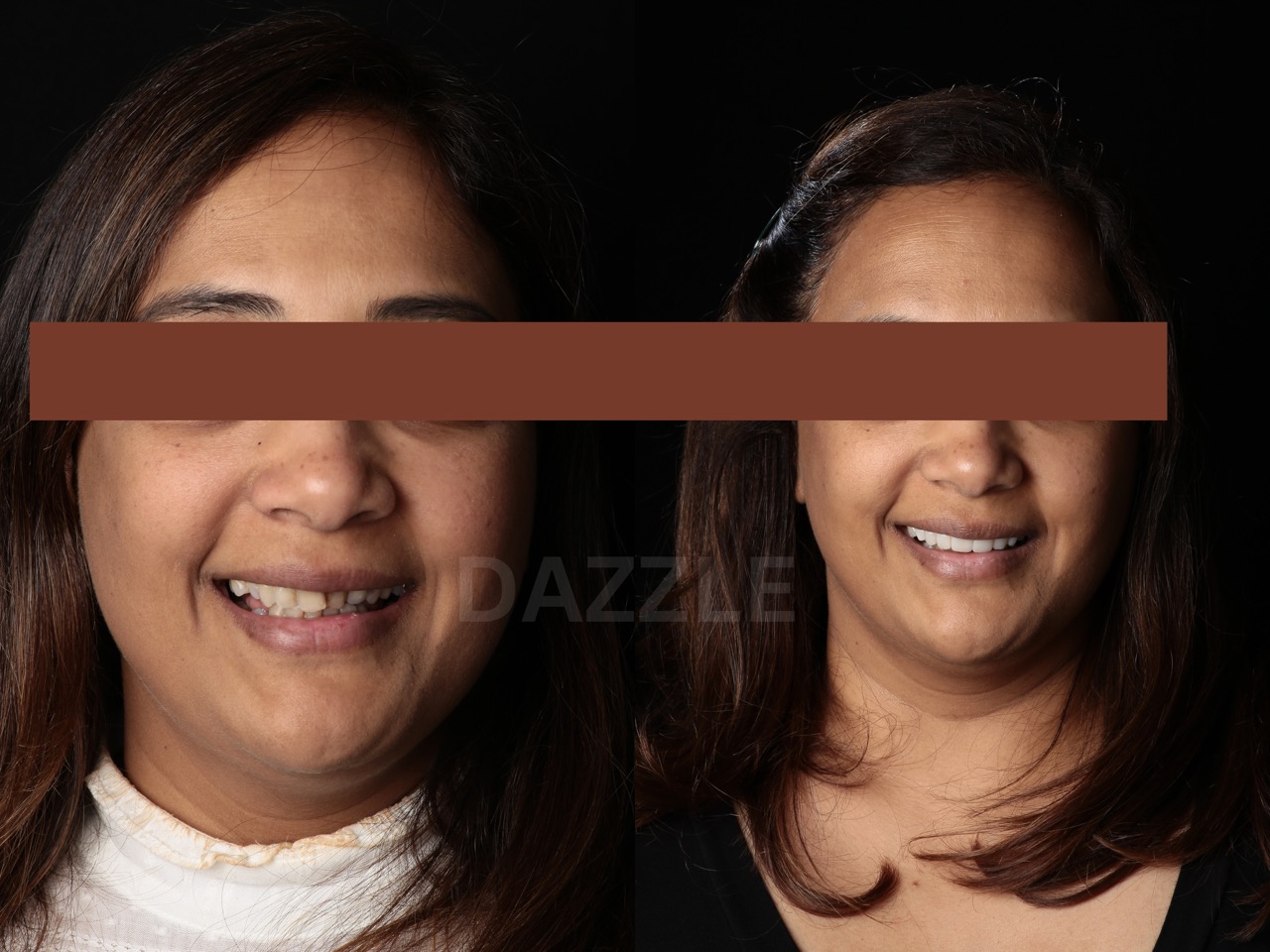 Before and after: woman's worn, uneven teeth restored to a whiter, more even smile