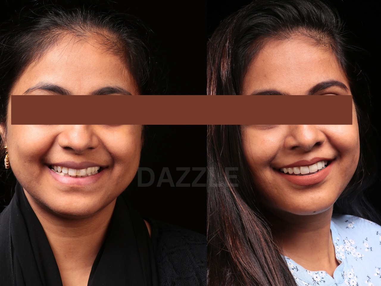 Before and after: young woman's teeth whitened and evened out for a brighter smile