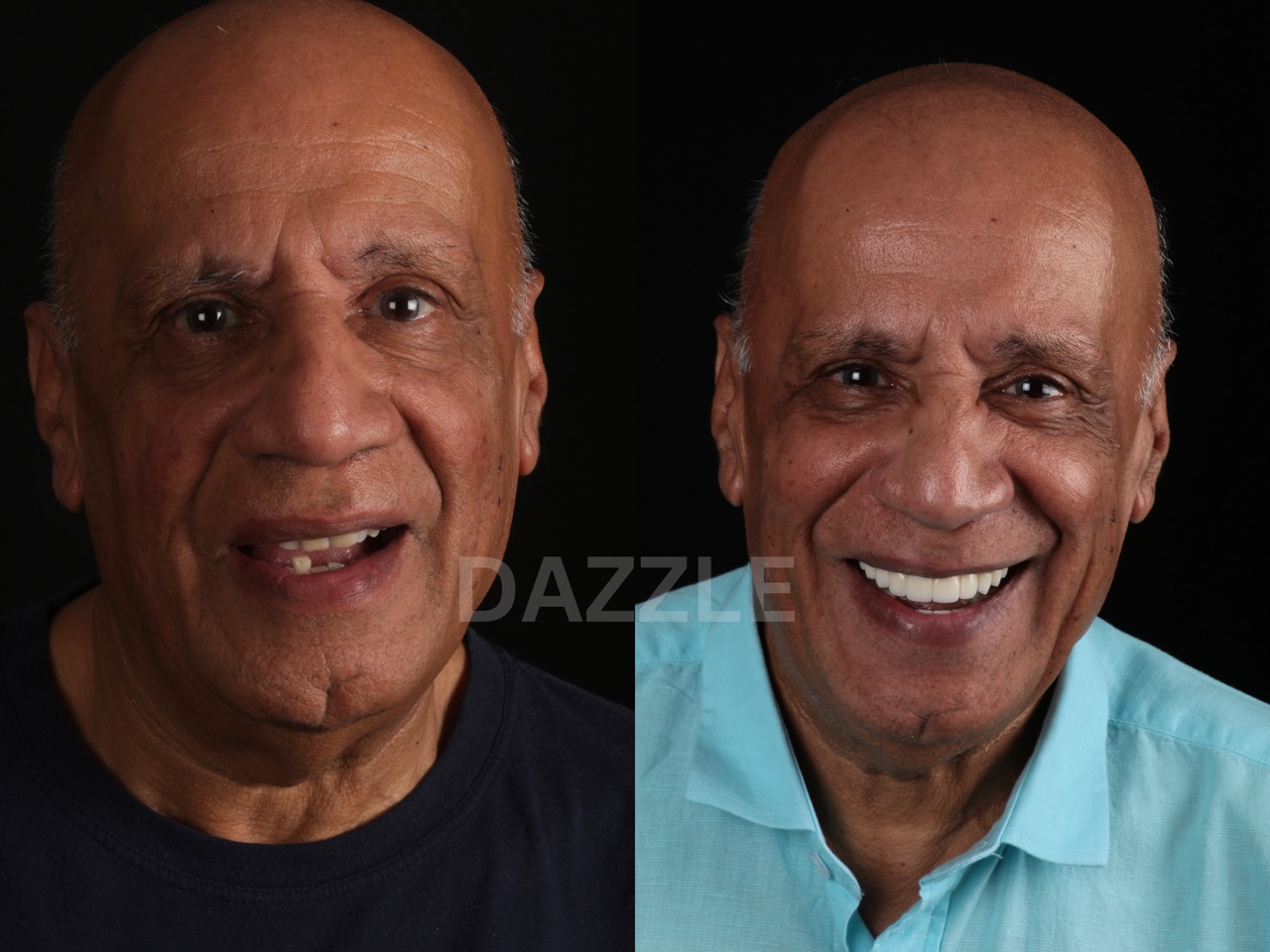Before and after: older man's smile restored from missing front teeth to a full, natural-looking set