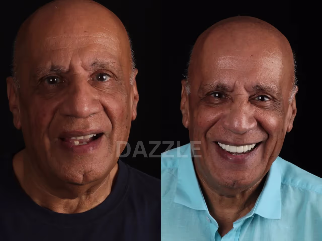 Before and after: older man's smile restored from missing front teeth to a full, natural-looking set
