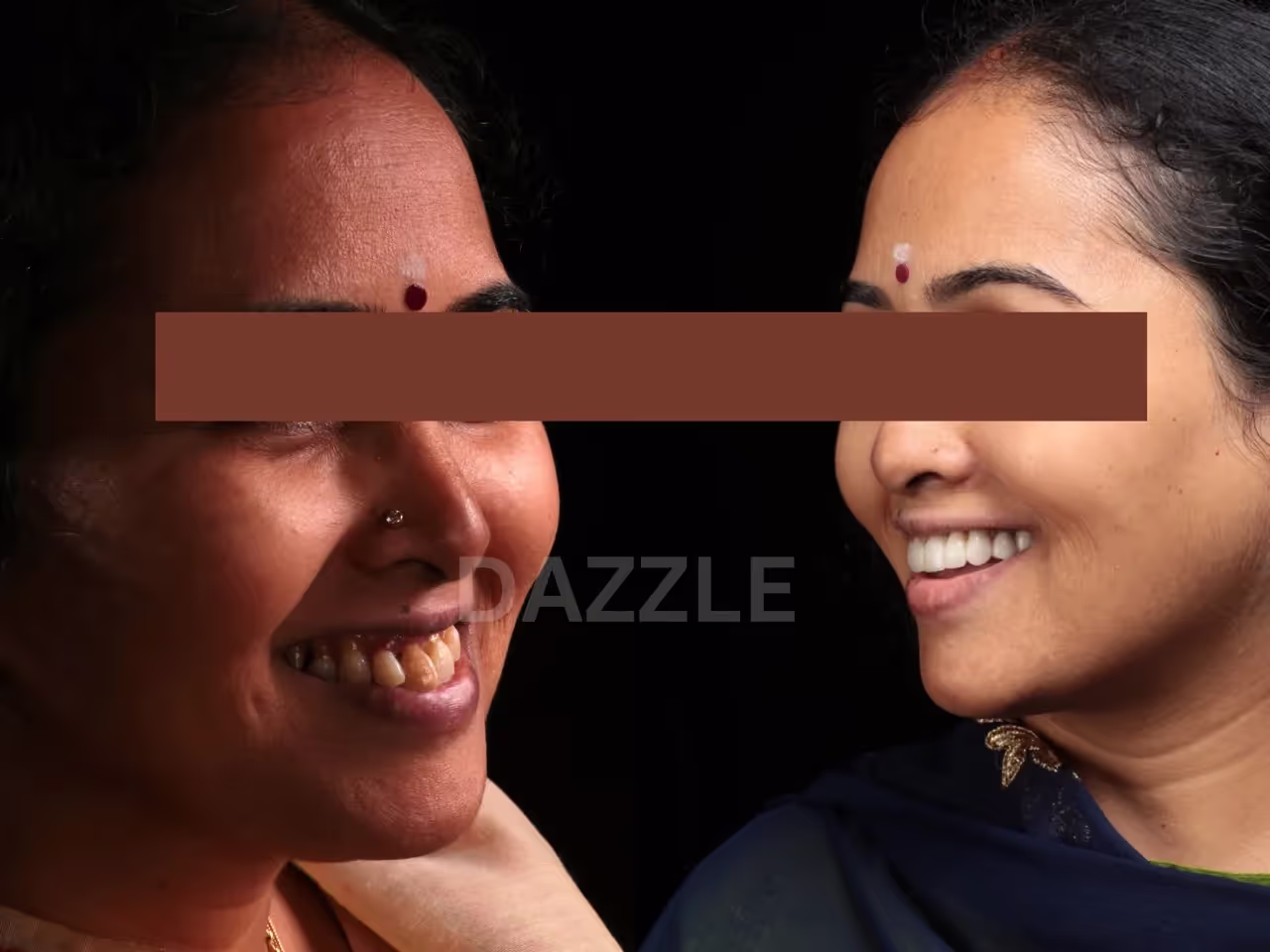 Before and after: woman's stained, uneven teeth transformed into a bright, even smile