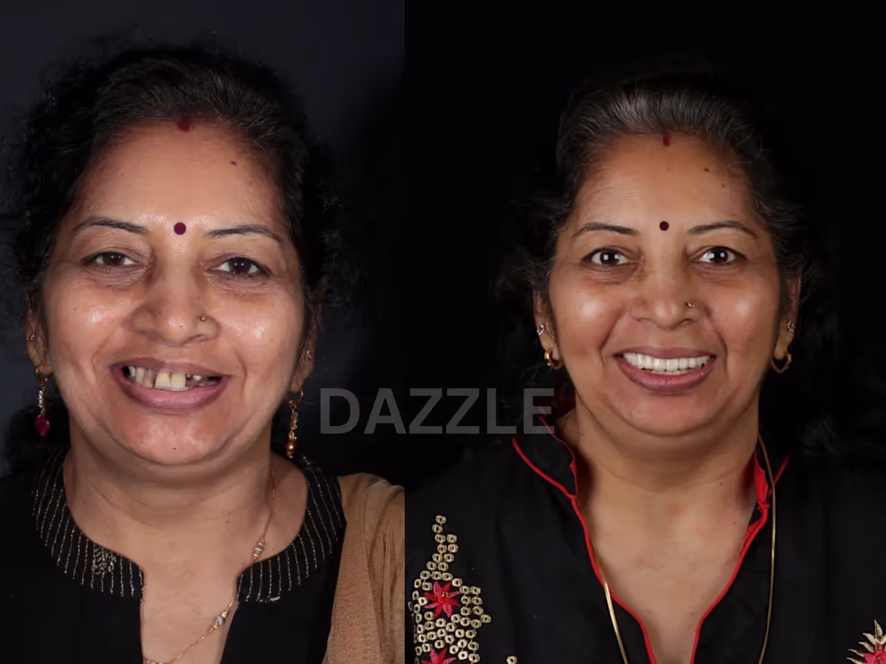 Before and after: woman's missing front tooth replaced, completing an even, natural smile