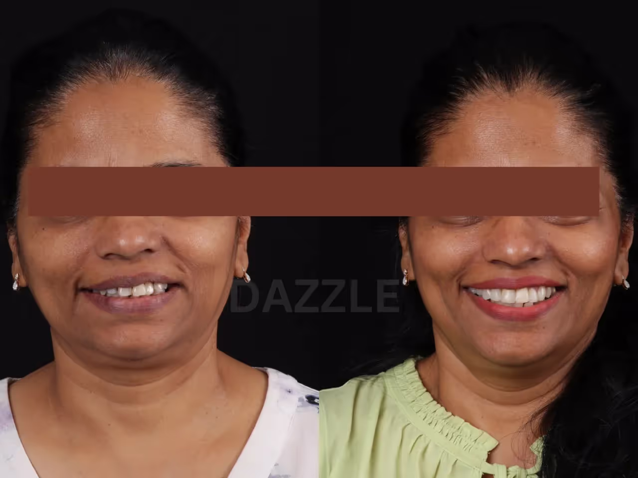 Before and after: woman's dull, uneven teeth restored to a brighter, more symmetrical smile