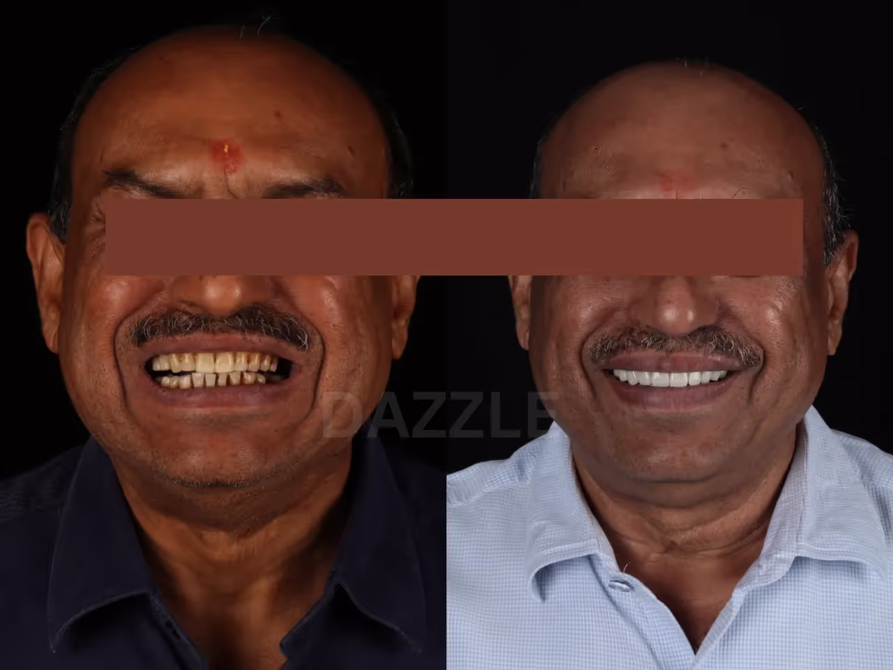 Before and after: man's yellowed, worn teeth replaced with a white, even full-arch smile