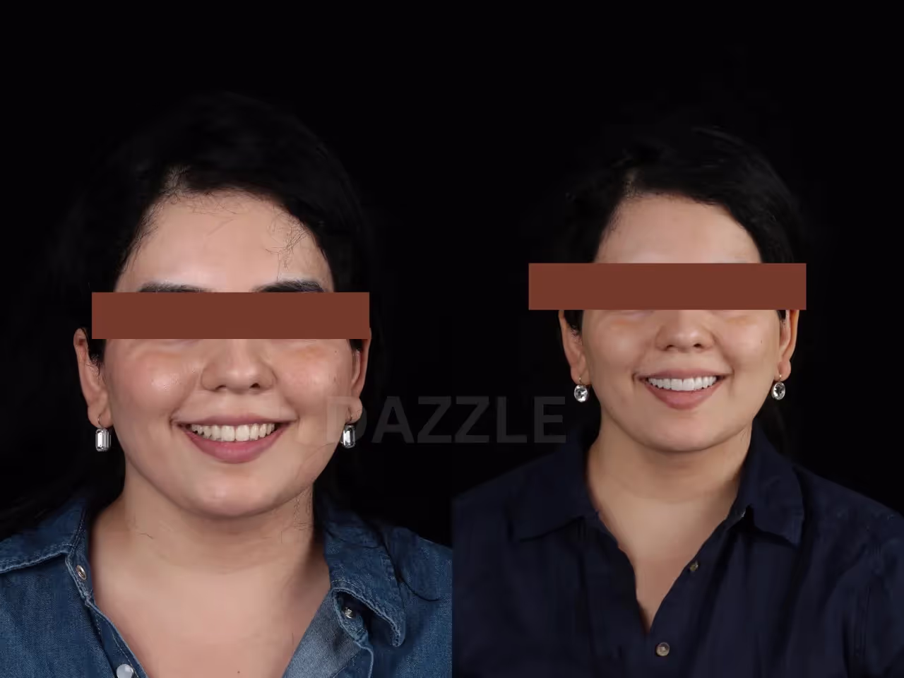 Before and after: woman's smile refined with whiter, more evenly shaped teeth