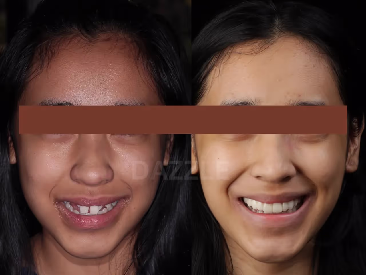Before and after: young woman's crowded, uneven teeth straightened into an aligned smile