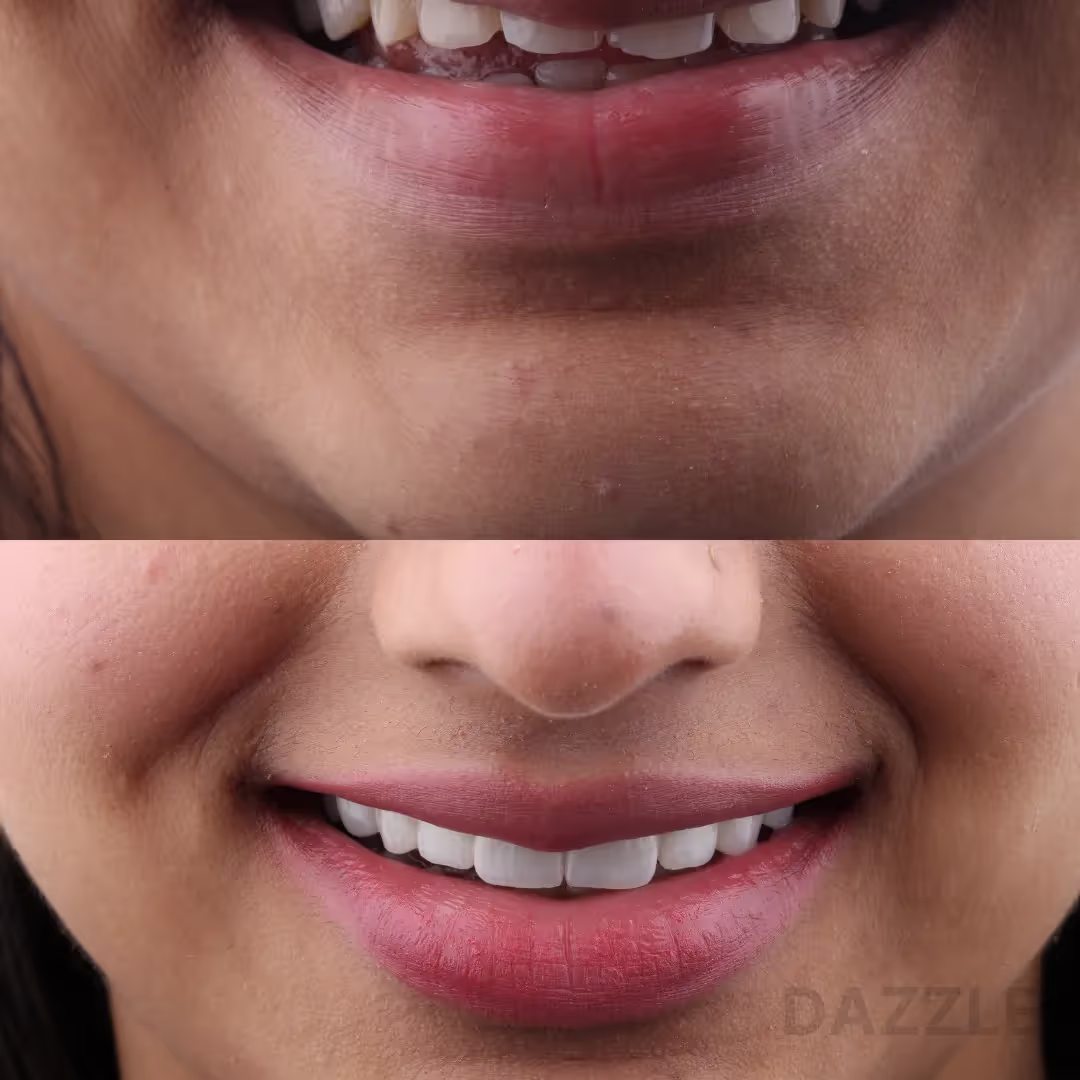 Close-up before and after: uneven front teeth reshaped into a smooth, even smile