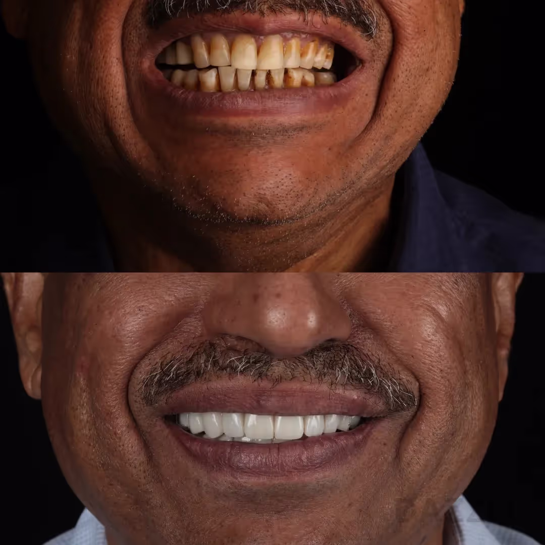 Close-up before and after: man's worn, yellowed teeth replaced with bright, even restorations