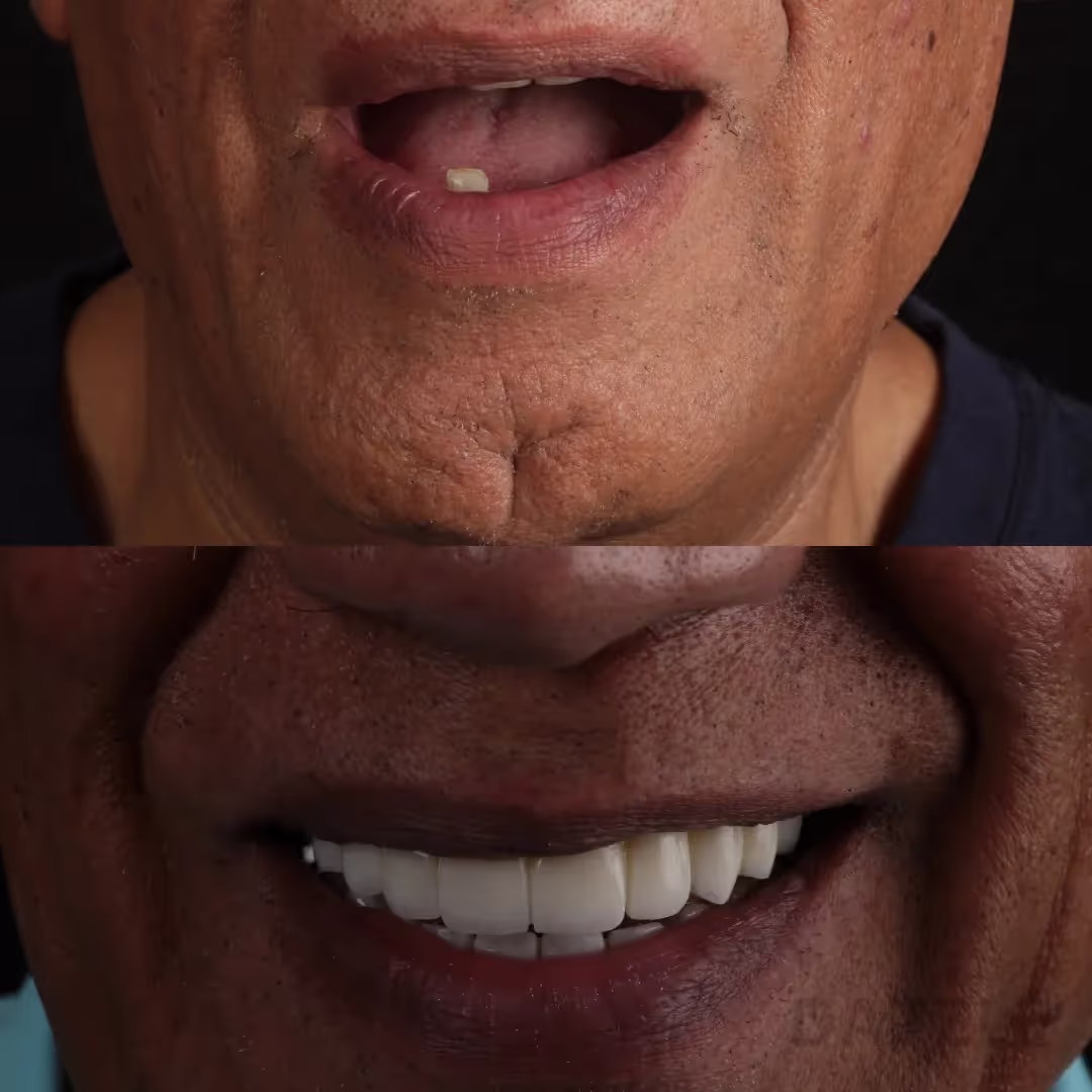 Close-up before and after: nearly toothless upper jaw restored with a full arch of fixed teeth