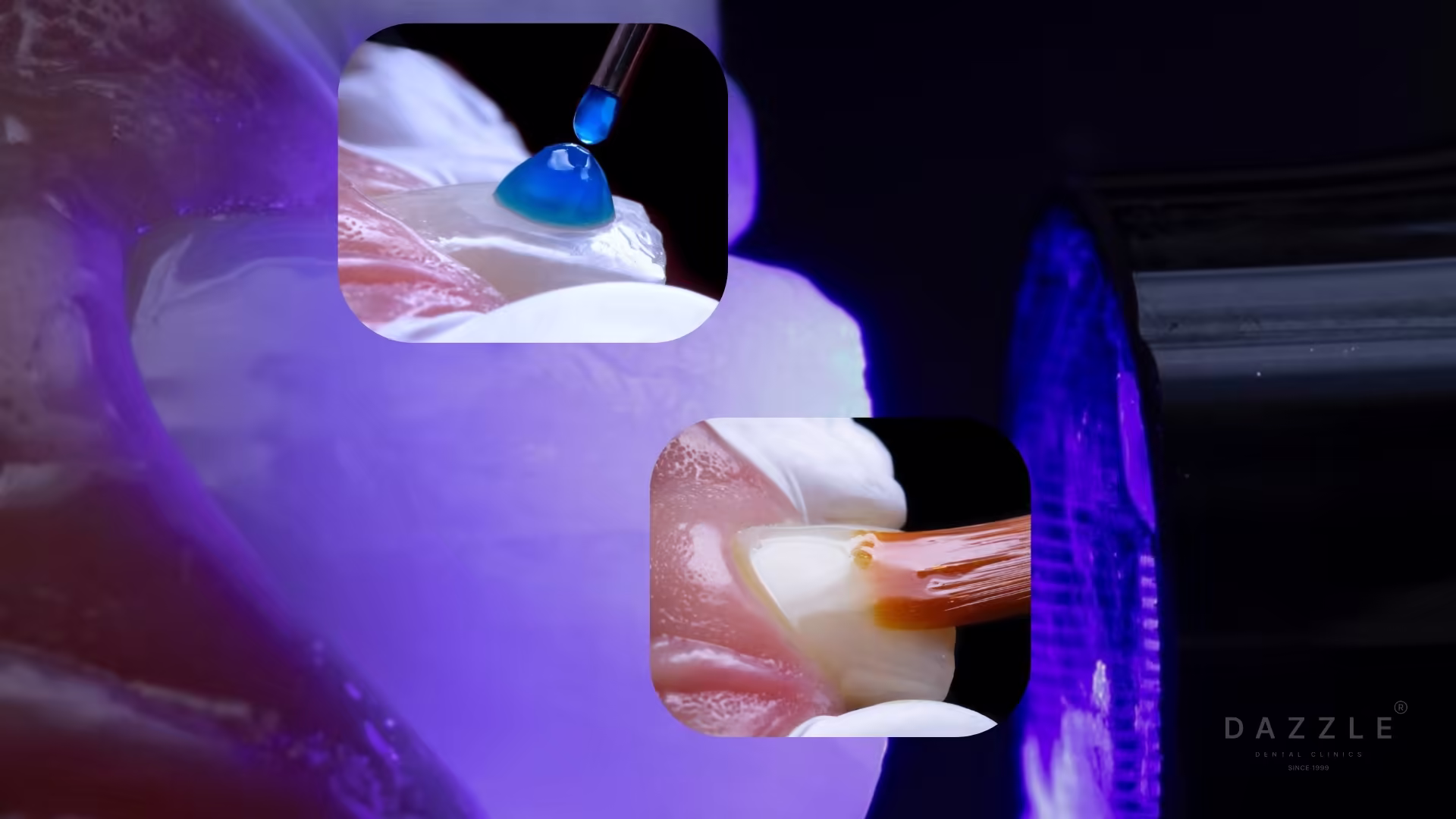 Composite Resin in Modern Dentistry: Types, Applications, and What Dazzle Dental Clinic Uses