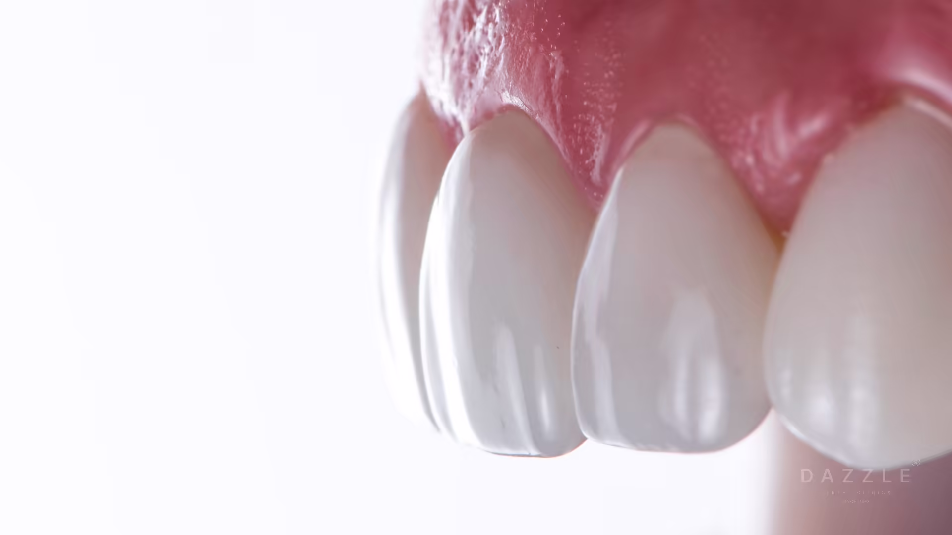 Minimal Prep Veneers at Dazzle Dental Mumbai: When Ultra-Thin Ceramic Is the Right Choice